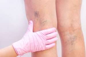 Jambes lourdes
